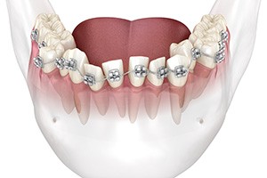 Illustration of crooked lower teeth with braces